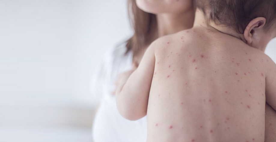 Рахіт у дітей: як нестача вітаміну Д руйнує кістки та що потрібно знати батькам